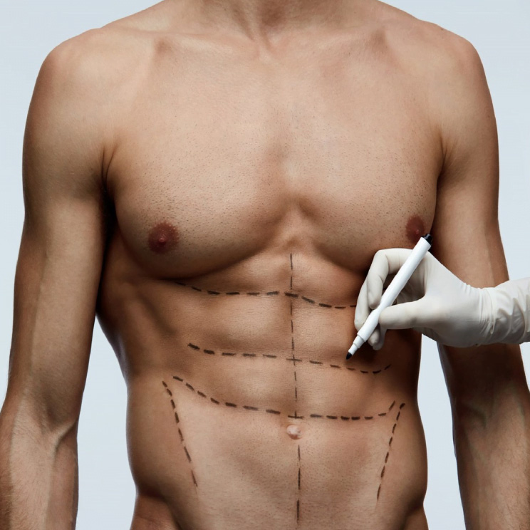 ABDOMINAL ETCHING