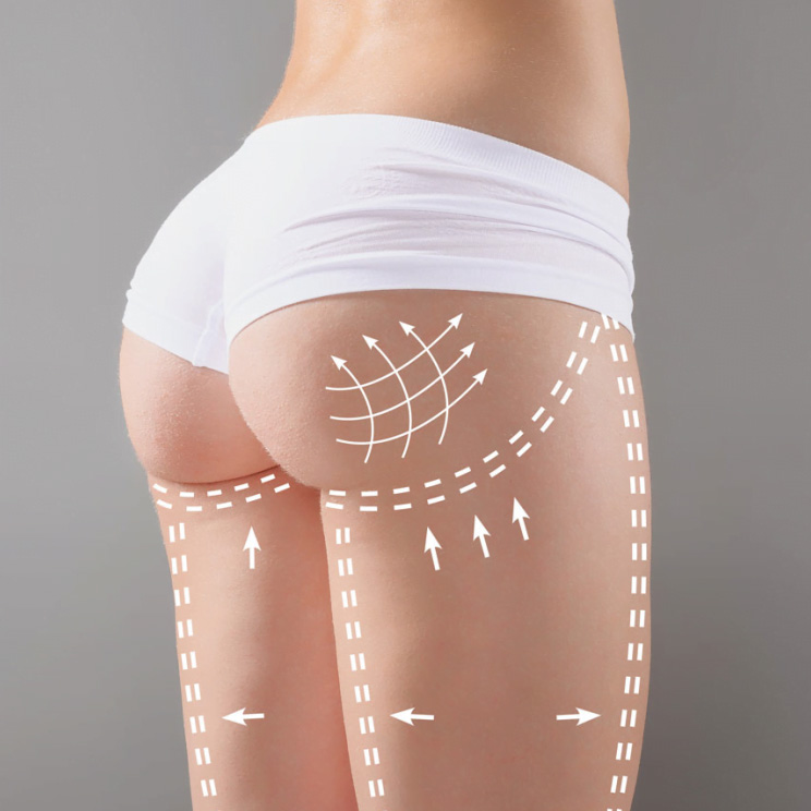 BRAZILIAN BUTT LIFT (BBL)