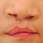 CLEFT LIP