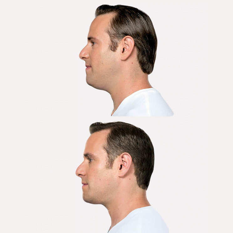 DOUBLE CHIN CORRECTION