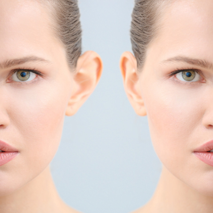 EAR SHAPE CORRECTION