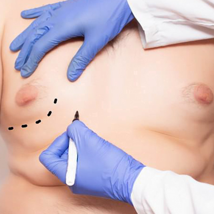GYNECOMASTIA