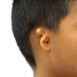 MICROTIA (CONGENITAL EAR DEFECTS)