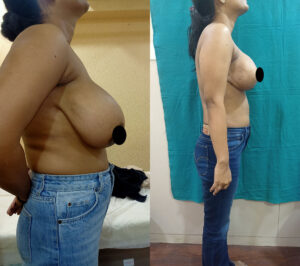 Breast-reduction-lift