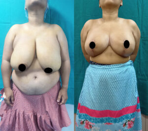 Breast-reduction-lift1