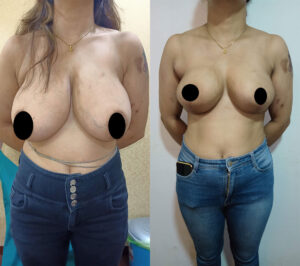 Breast-reduction-lift2