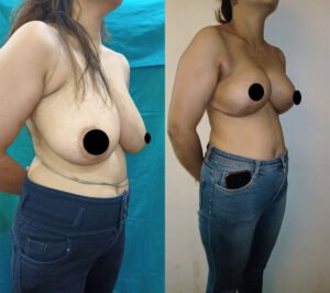 Breast-reduction-lift4
